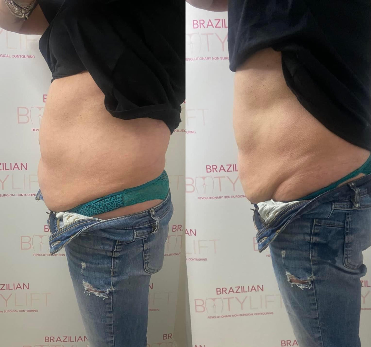 Non-Surgical Tummy Tuck (Course of 5)