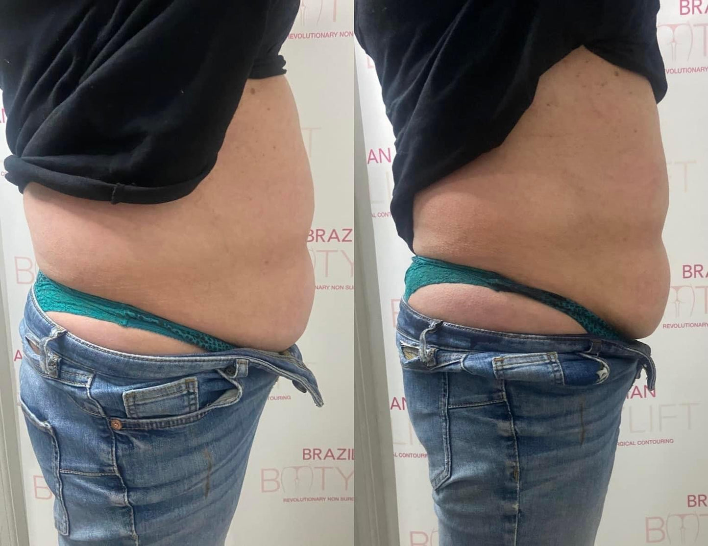 Non-Surgical Tummy Tuck (Course of 5)