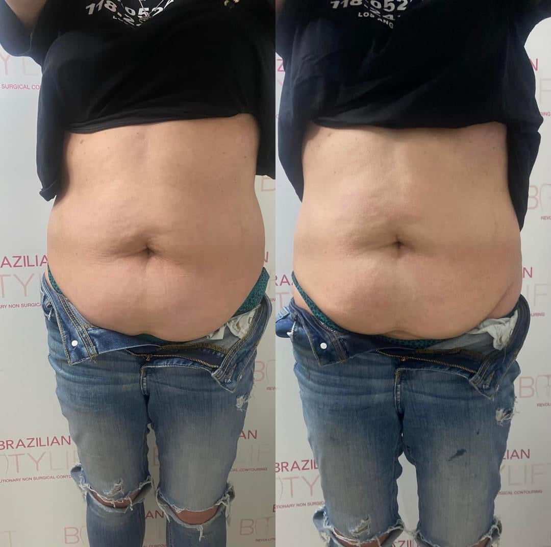 Non-Surgical Tummy Tuck (Course of 5)