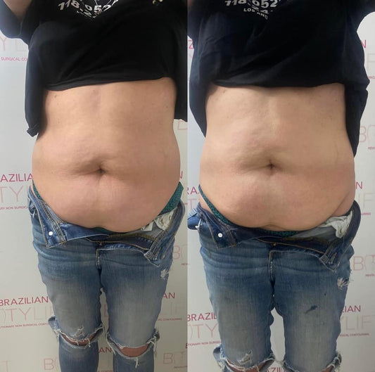 Non-Surgical Tummy Tuck (Course of 5)