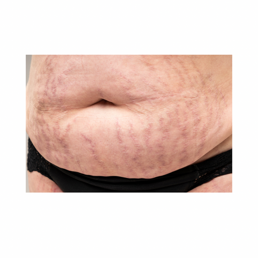 Stretch Mark reduction