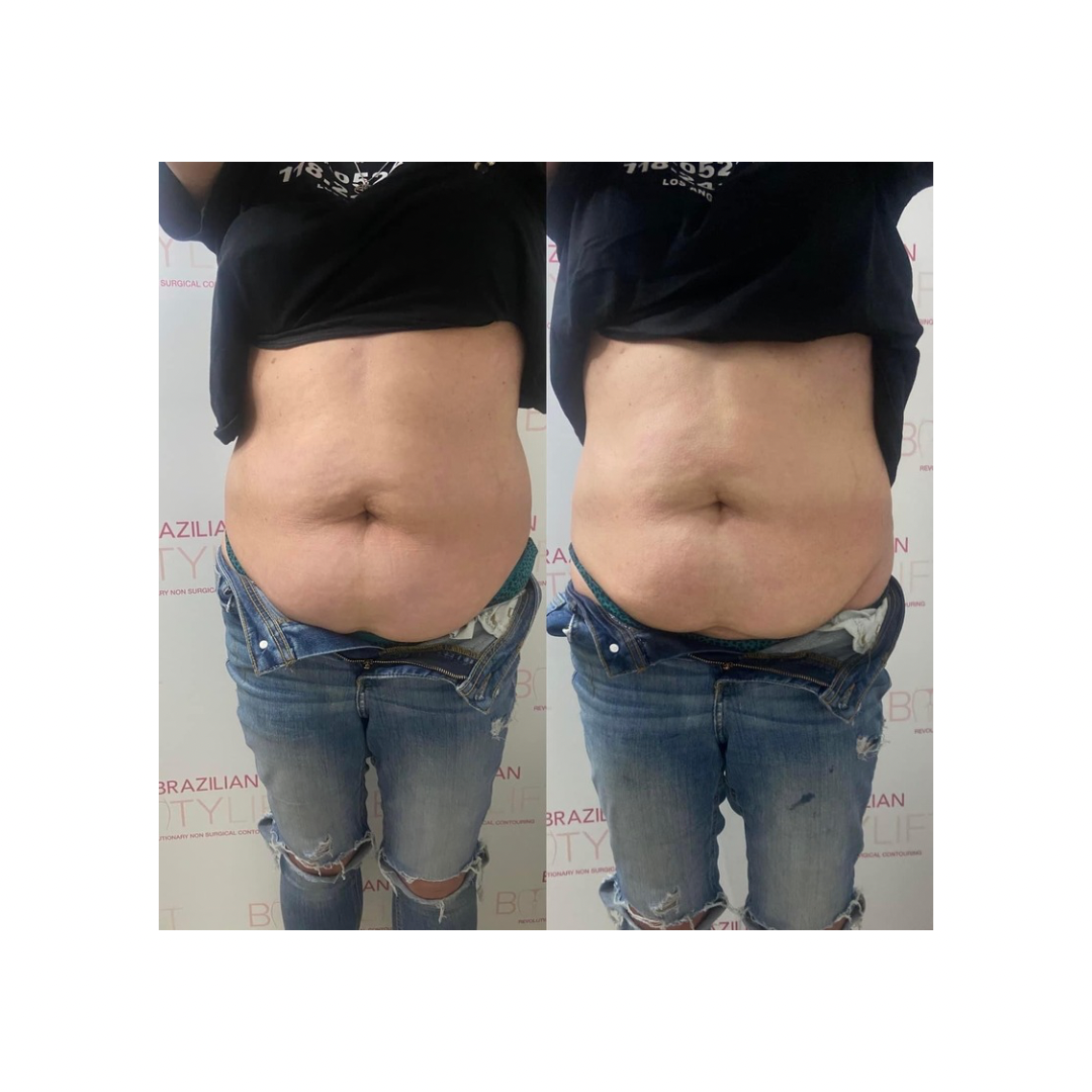 Non-Surgical Tummy Tuck (Single Session)